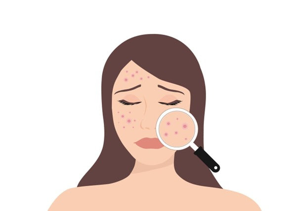 How to Tackle Acne-Prone Skin: Tips for Clearer, Healthier Skin